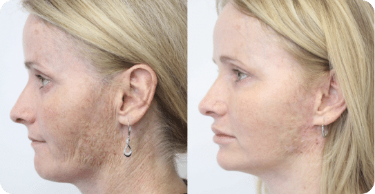 Facial rejuvenation results from side profile