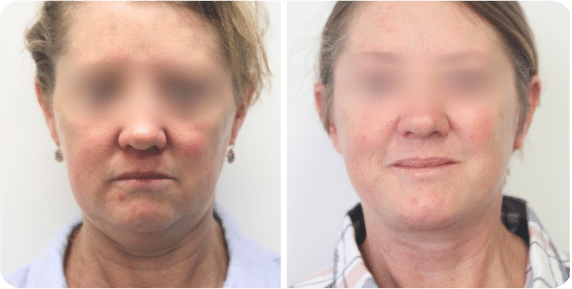 Before and after results of male chest reduction surgery with logo of Dr Kevin Ho