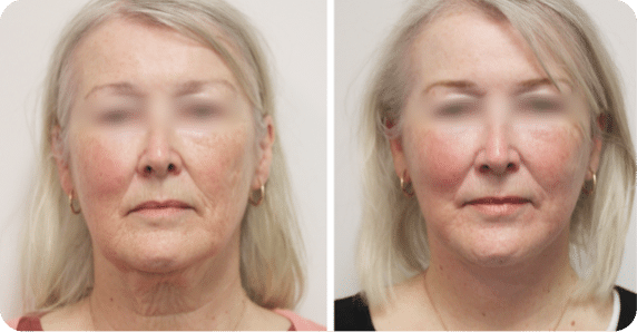 Before and after tummy tuck results.