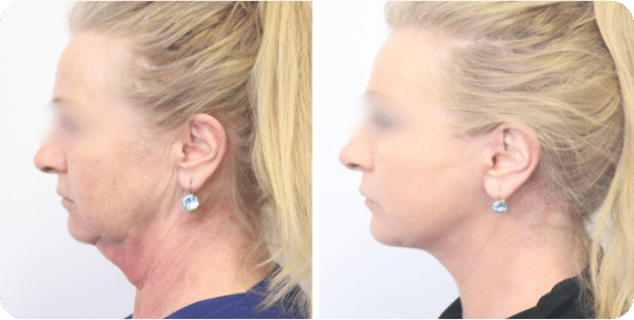 Before and after neck lift results.